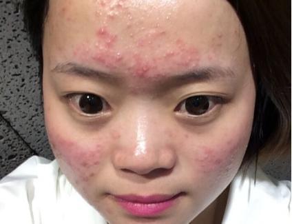 谢谢那些叫我「青春美丽疙瘩痘」的人，你们成功让我自卑了整个青春期