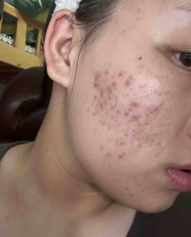 痤疮患者饮食清单：能吃 vs 忌口一次说清