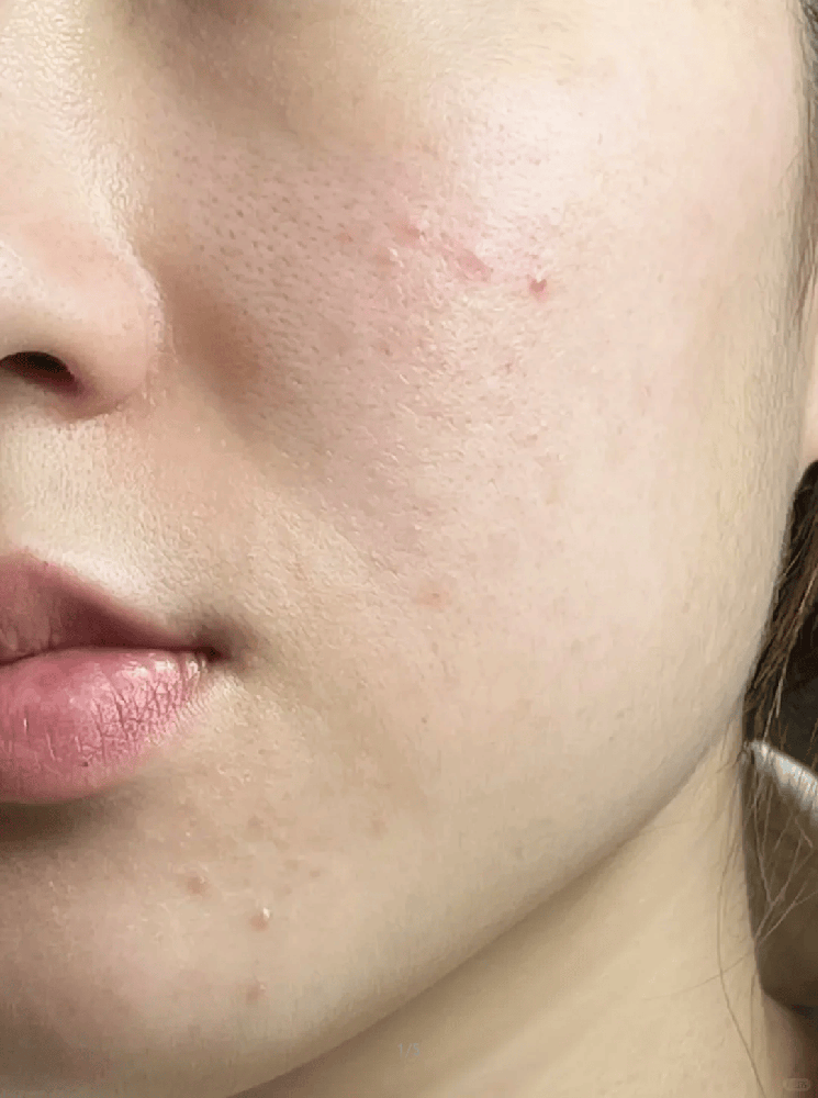 祛痘期间，自卑像影子一样黏人：镜子不敢照，低头快走，合照躲边。